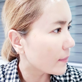 다이어트 성공해서 이마 자가지방넣었는데. 잘됐나요?
